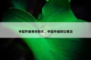 中超外援骨折照片，中超外援到位情况